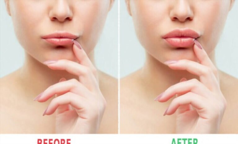 How to Get Bigger Lips Permanently Without Surgery